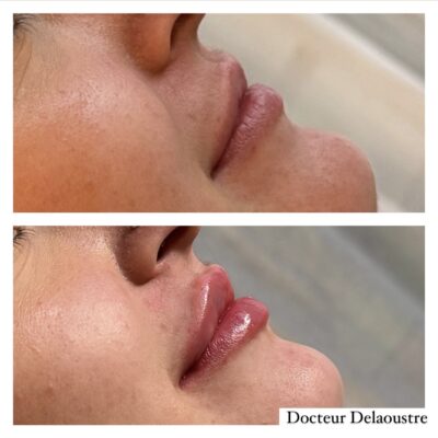 injections acide hyaluronique lèvres à Lille