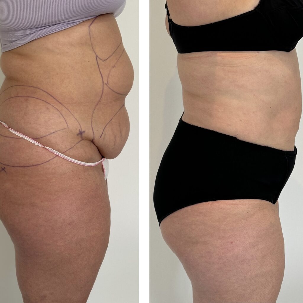 Liposuccion médicale à Lille