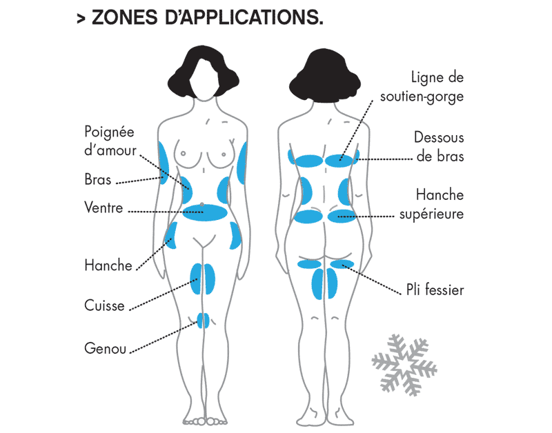 Zones de traitement par cryolipolyse à Lille