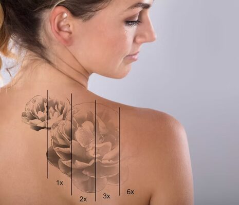 Détatouage Laser Lille