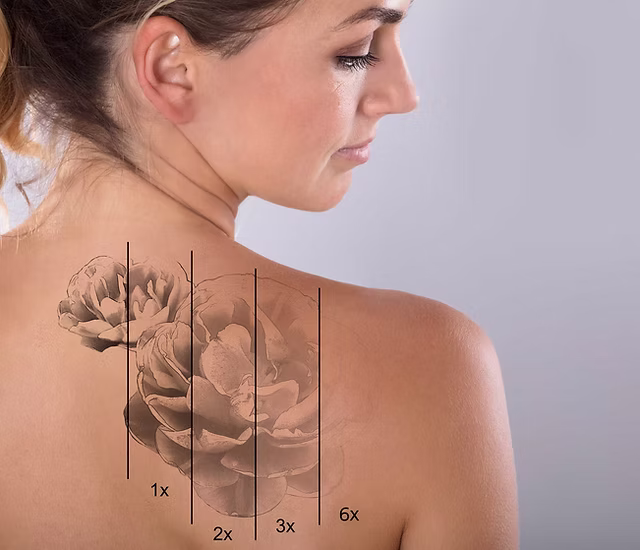 Détatouage Laser Lille
