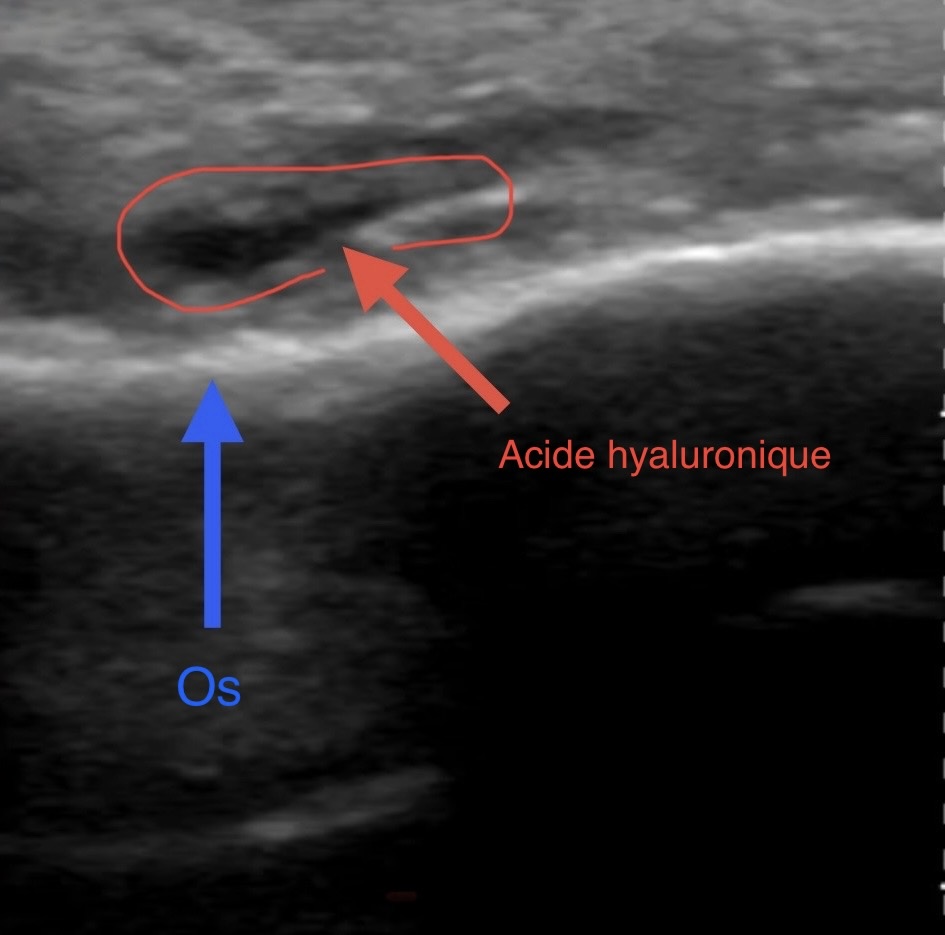 Dissoudre l'acide hyaluronique avec du hyaluronidase