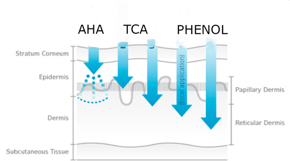 Peeling fort au TCA+phénol à Lille