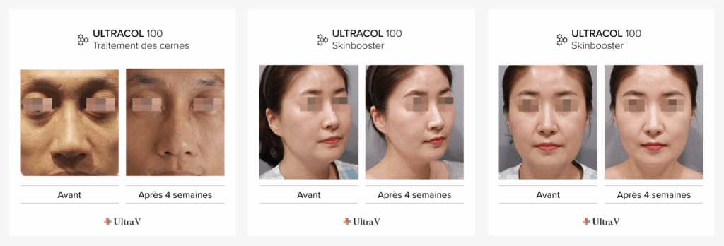 ultracol lille injectionn acide hyaluronique docteur delaoustre