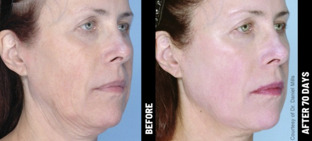 Ulthera lille docteur delaoustre médecin esthétique lille hifu