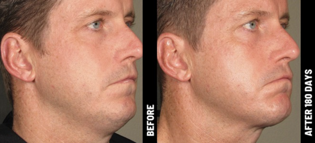 Ulthera lille docteur delaoustre médecin esthétique lille hifu