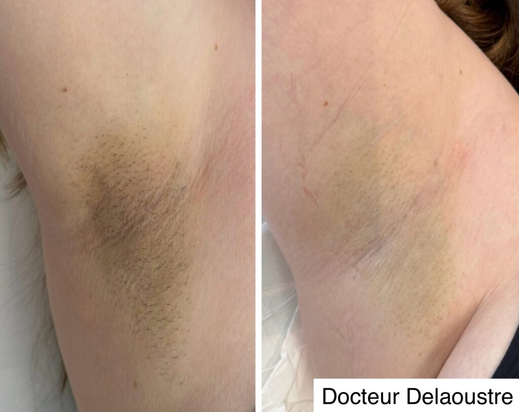hyperpigmentation des aisselles lille docteur delaoustre laser pigmentation
