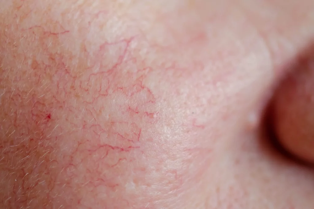 couperose rougeurs vaisseaux lille docteur delaoustre