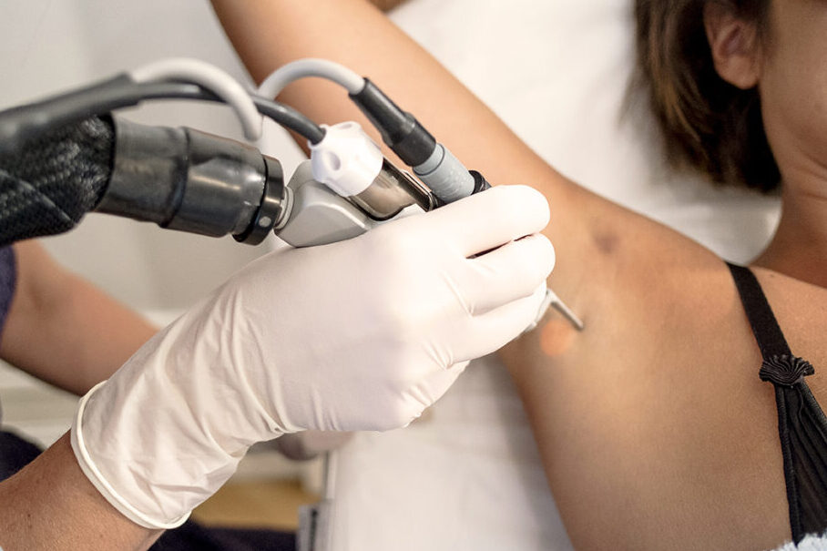 hyperpigmentation aisselles lille docteur delaoustre 